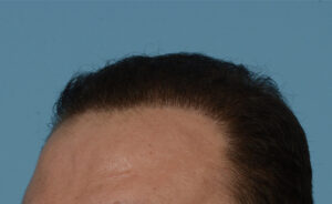 Fue Before and After | Dr. Jeffrey Wise