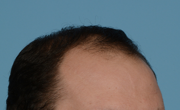 Fue Before and After | Dr. Jeffrey Wise