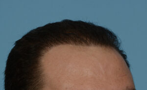 Fue Before and After | Dr. Jeffrey Wise