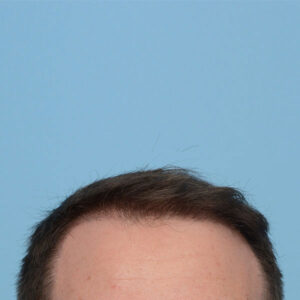 Fue Before and After | Dr. Jeffrey Wise