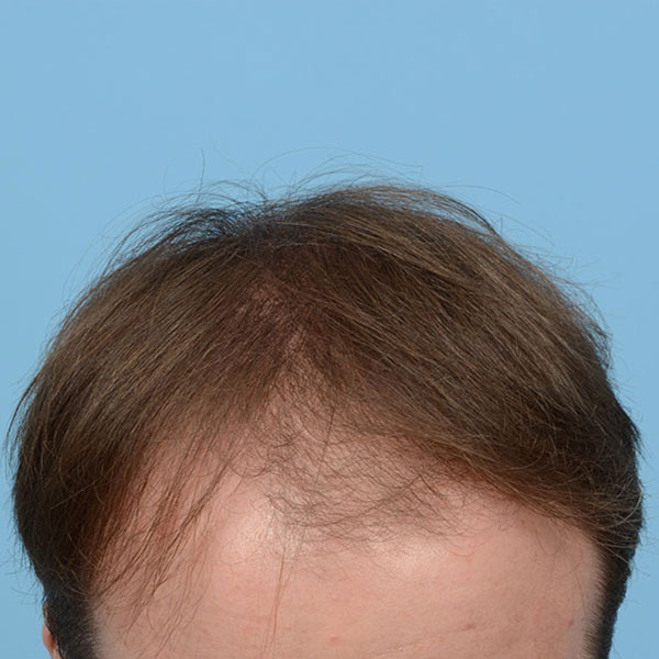 Fue Before and After | Dr. Jeffrey Wise