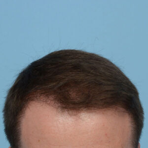 Fue Before and After | Dr. Jeffrey Wise