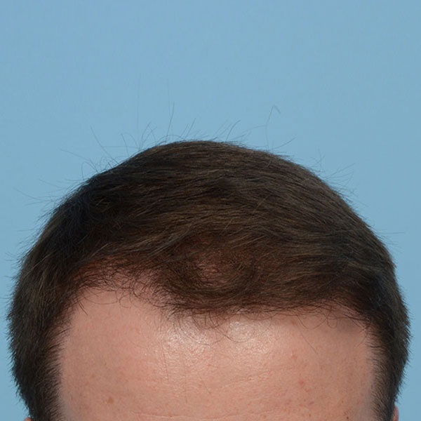 Fue Before and After | Dr. Jeffrey Wise