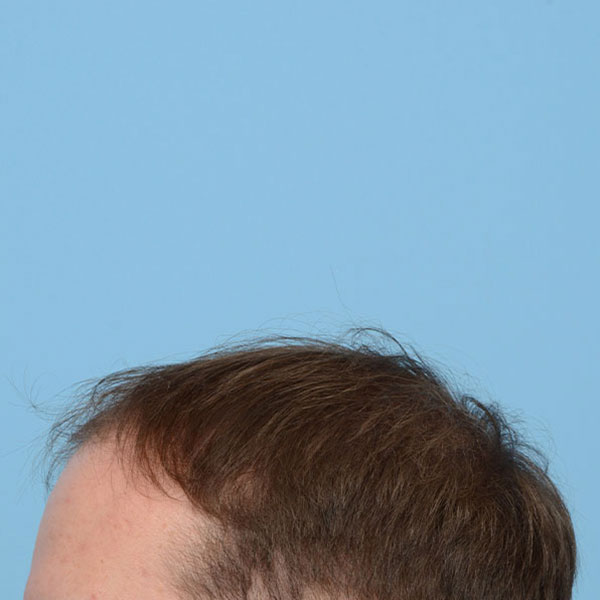 Fue Before and After | Dr. Jeffrey Wise