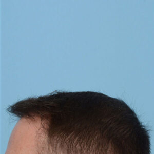 Fue Before and After | Dr. Jeffrey Wise