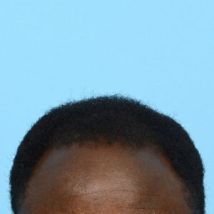 Fue Before and After | Dr. Jeffrey Wise