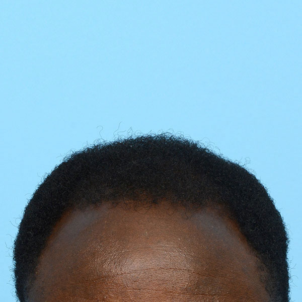 Fue Before and After | Dr. Jeffrey Wise