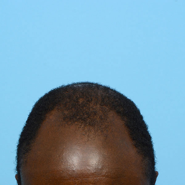 Fue Before and After | Dr. Jeffrey Wise