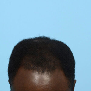 Fue Before and After | Dr. Jeffrey Wise