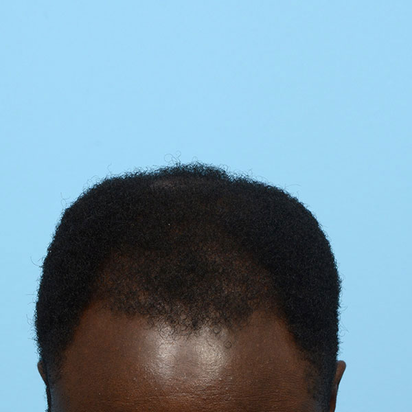 Fue Before and After | Dr. Jeffrey Wise