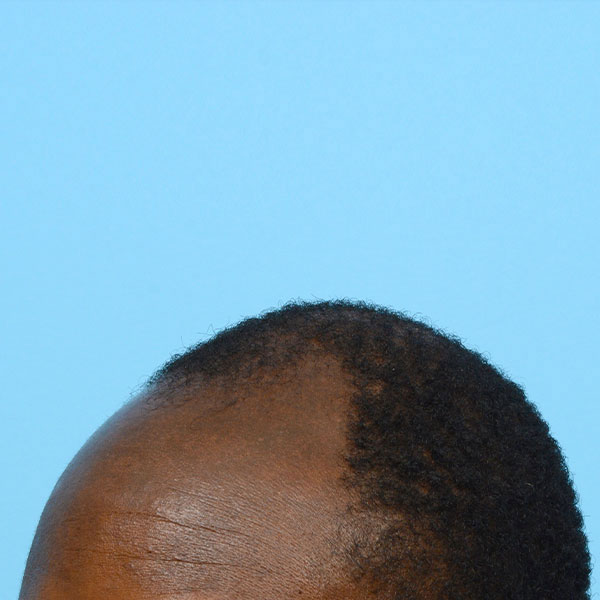 Fue Before and After | Dr. Jeffrey Wise