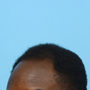 Fue Before and After | Dr. Jeffrey Wise