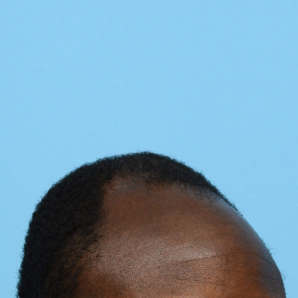 Fue Before and After | Dr. Jeffrey Wise