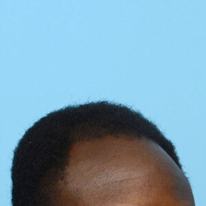 Fue Before and After | Dr. Jeffrey Wise