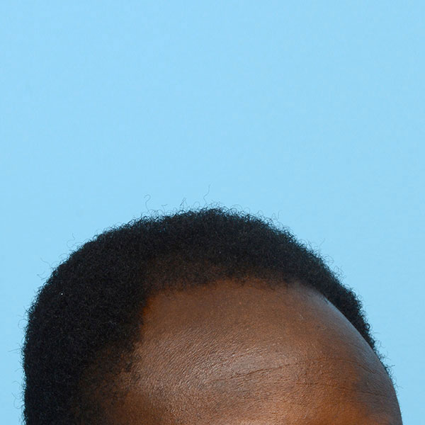 Fue Before and After | Dr. Jeffrey Wise