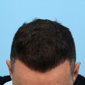 Fue Before and After | Dr. Jeffrey Wise