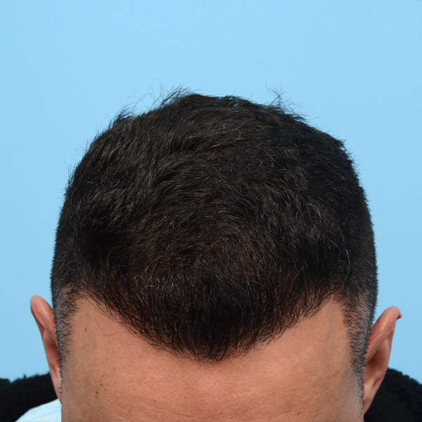 Fue Before and After | Dr. Jeffrey Wise