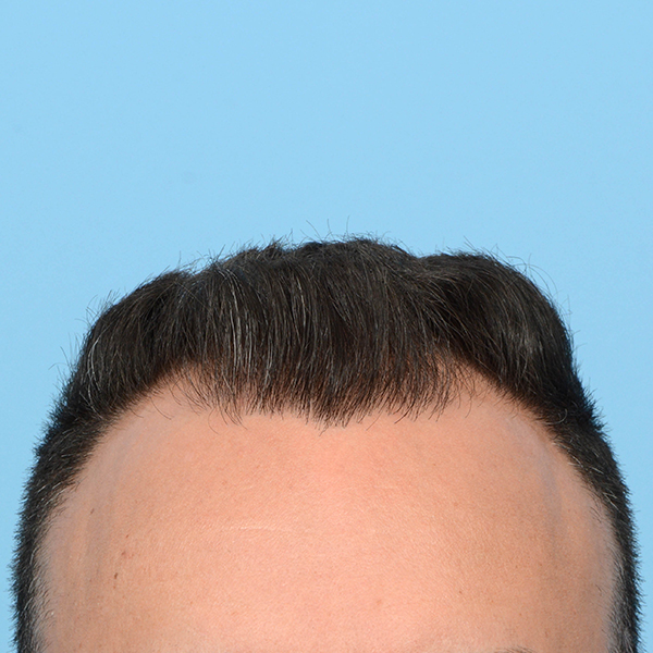 Fue Before and After | Dr. Jeffrey Wise