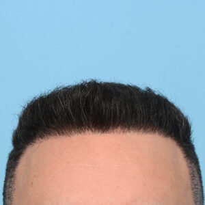 Fue Before and After | Dr. Jeffrey Wise