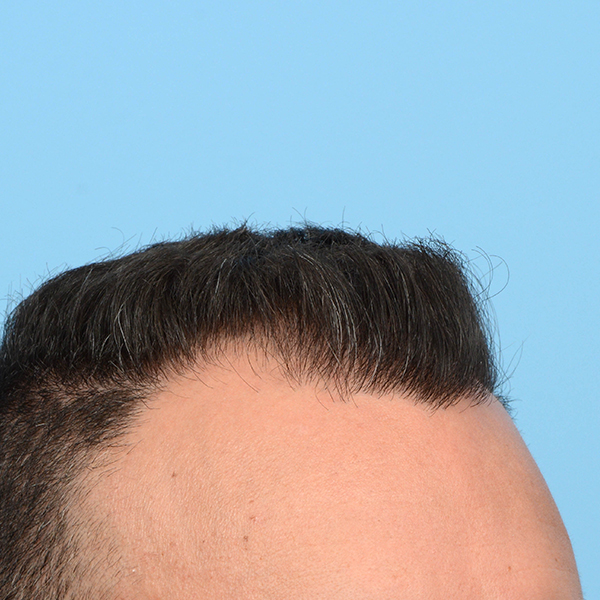 Fue Before and After | Dr. Jeffrey Wise