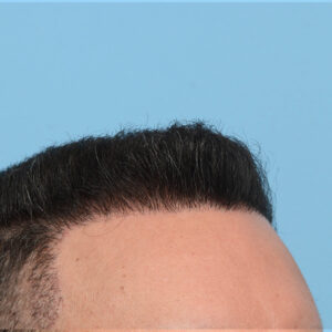 Fue Before and After | Dr. Jeffrey Wise
