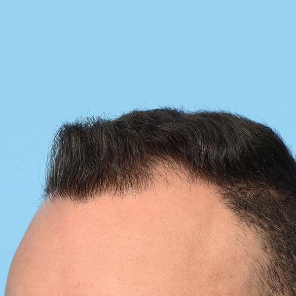 Fue Before and After | Dr. Jeffrey Wise