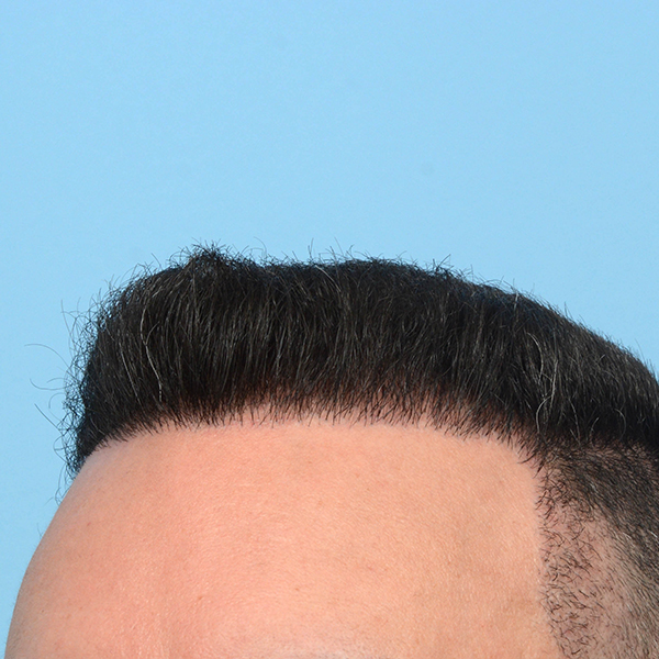 Fue Before and After | Dr. Jeffrey Wise