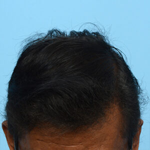 Fue Before and After | Dr. Jeffrey Wise