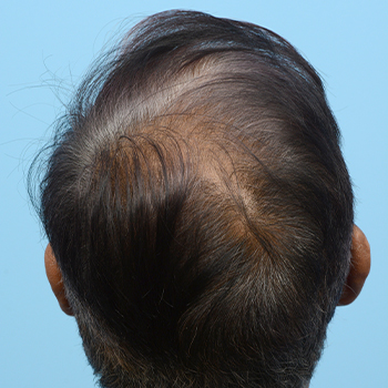 Fue Before and After | Dr. Jeffrey Wise