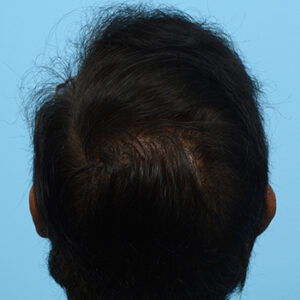 Fue Before and After | Dr. Jeffrey Wise