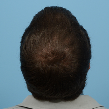 Fue Before and After | Dr. Jeffrey Wise