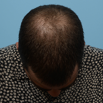 Fue Before and After | Dr. Jeffrey Wise