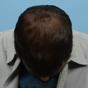 Fue Before and After | Dr. Jeffrey Wise