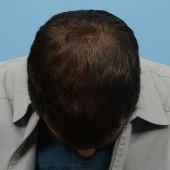 Fue Before and After | Dr. Jeffrey Wise
