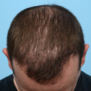 Fue Before and After | Dr. Jeffrey Wise