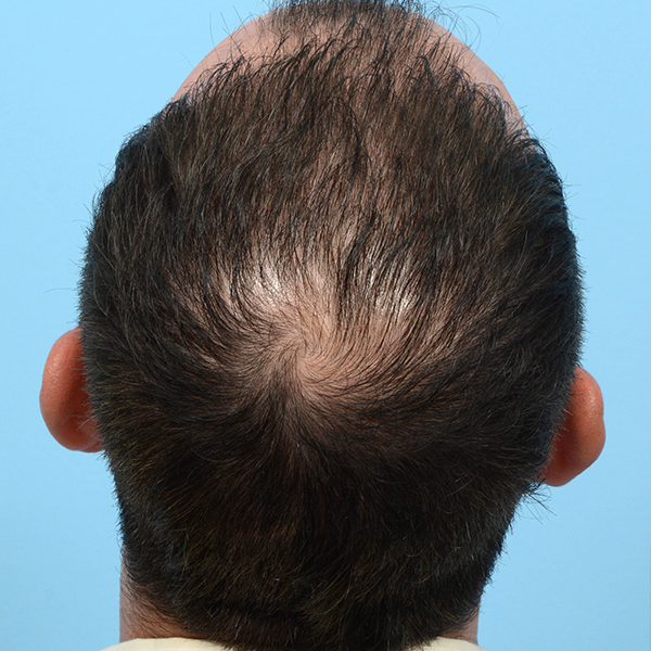 Fue Before and After | Dr. Jeffrey Wise
