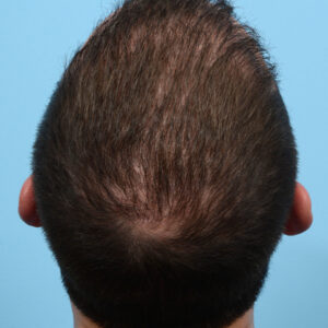 Fue Before and After | Dr. Jeffrey Wise
