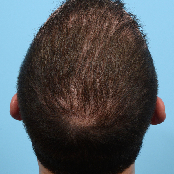 Fue Before and After | Dr. Jeffrey Wise