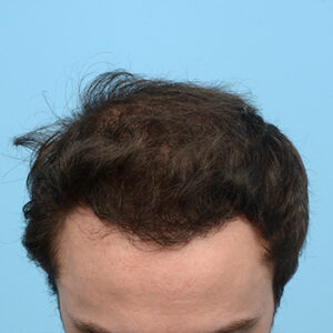 Fue Before and After | Dr. Jeffrey Wise