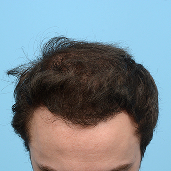 Fue Before and After | Dr. Jeffrey Wise