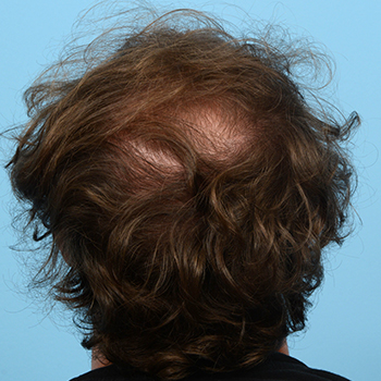 Fue Before and After | Dr. Jeffrey Wise