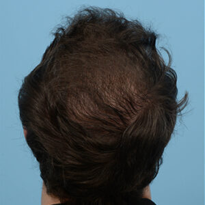 Fue Before and After | Dr. Jeffrey Wise
