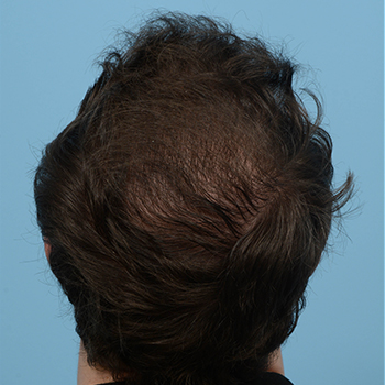 Fue Before and After | Dr. Jeffrey Wise