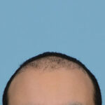 Fue Before and After | Dr. Jeffrey Wise