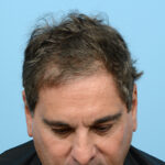 Fue Before and After | Dr. Jeffrey Wise