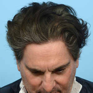Fue Before and After | Dr. Jeffrey Wise