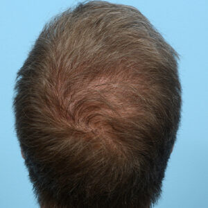 Fue Before and After | Dr. Jeffrey Wise
