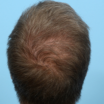 Fue Before and After | Dr. Jeffrey Wise