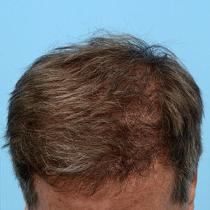 Fue Before and After | Dr. Jeffrey Wise