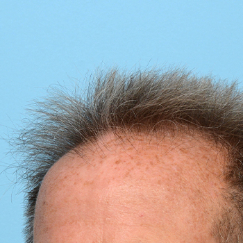 Fue Before and After | Dr. Jeffrey Wise